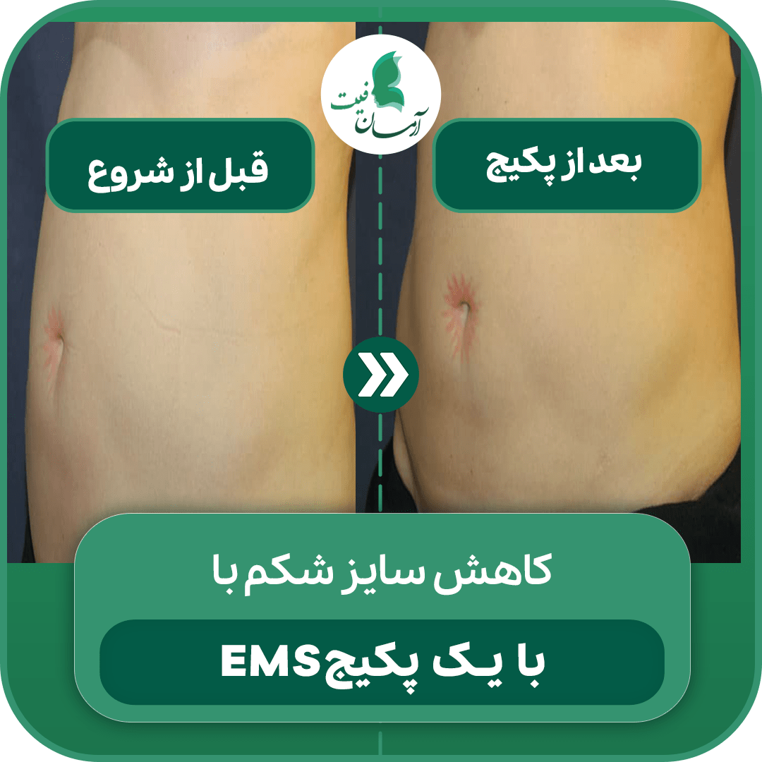 کاهش سایز با ems