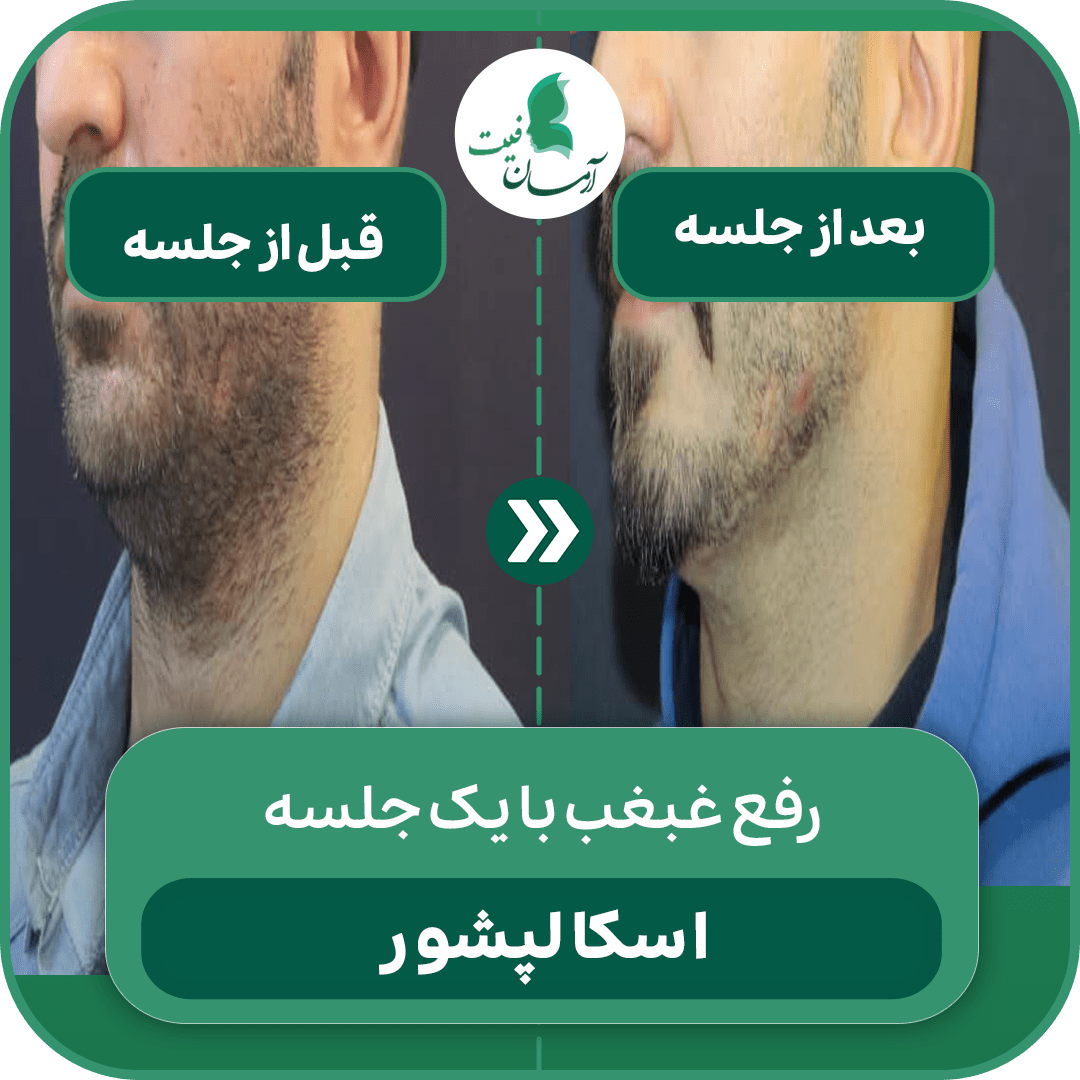 لاغری با اسکالپشور