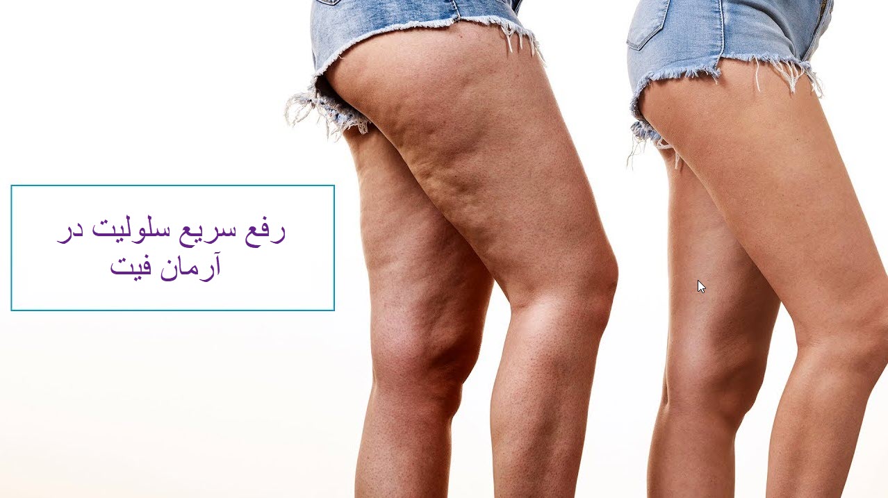 دستگاه های رفع سلولیت