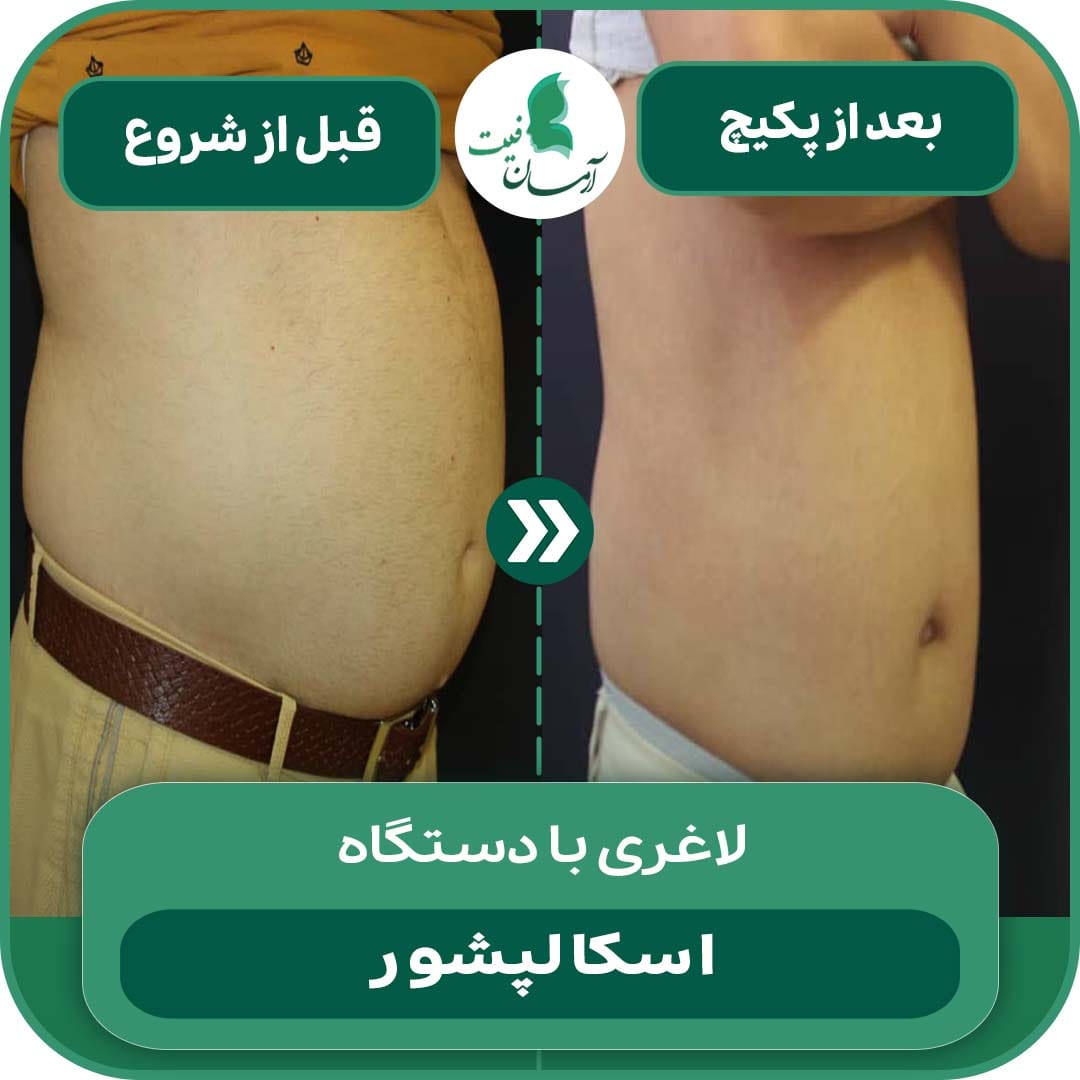 عکس و بعد لاغری با اسکالپشور