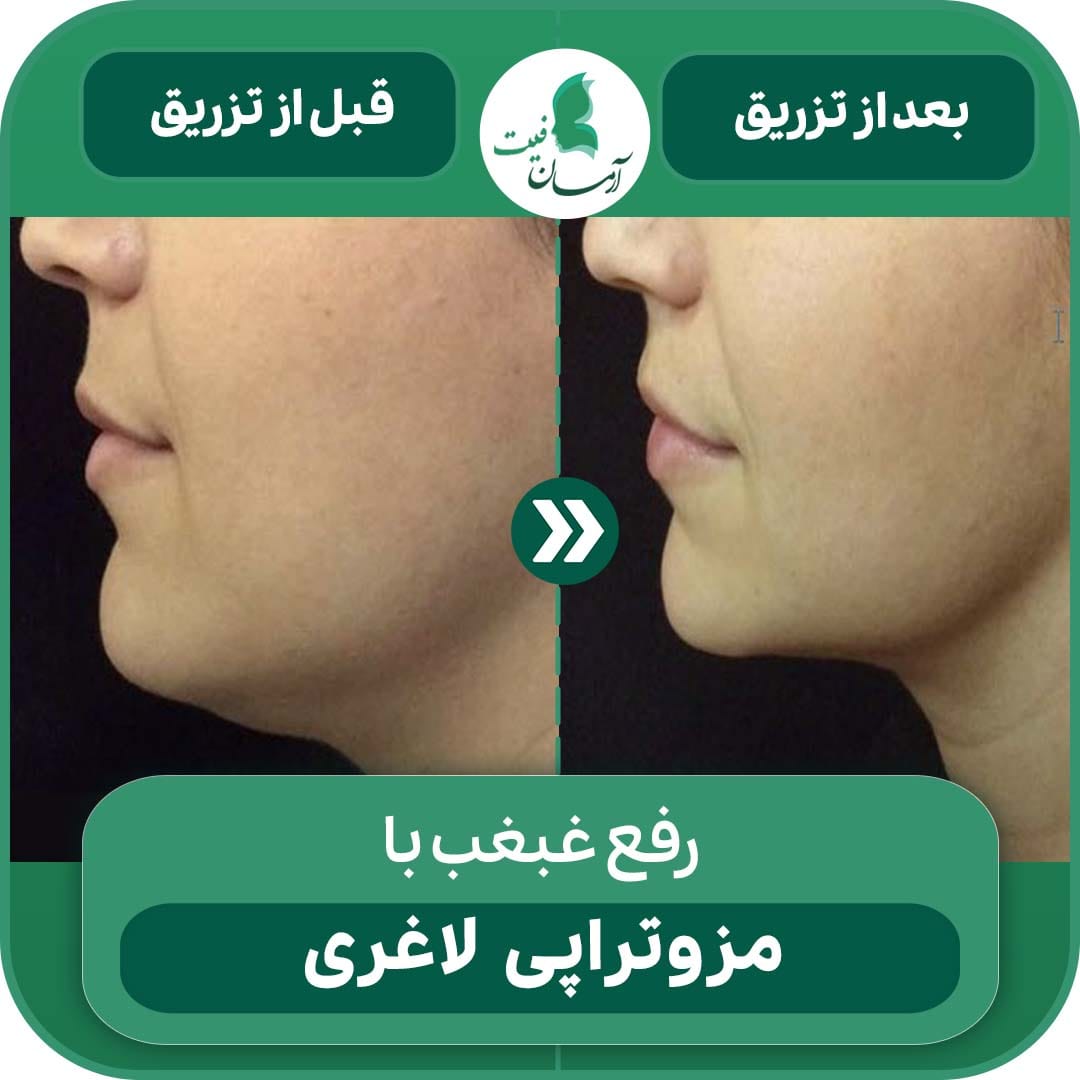 رفع غبغب با مزوتراپی