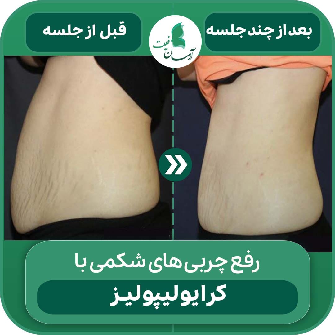 لاغری با کرایولیپولیز