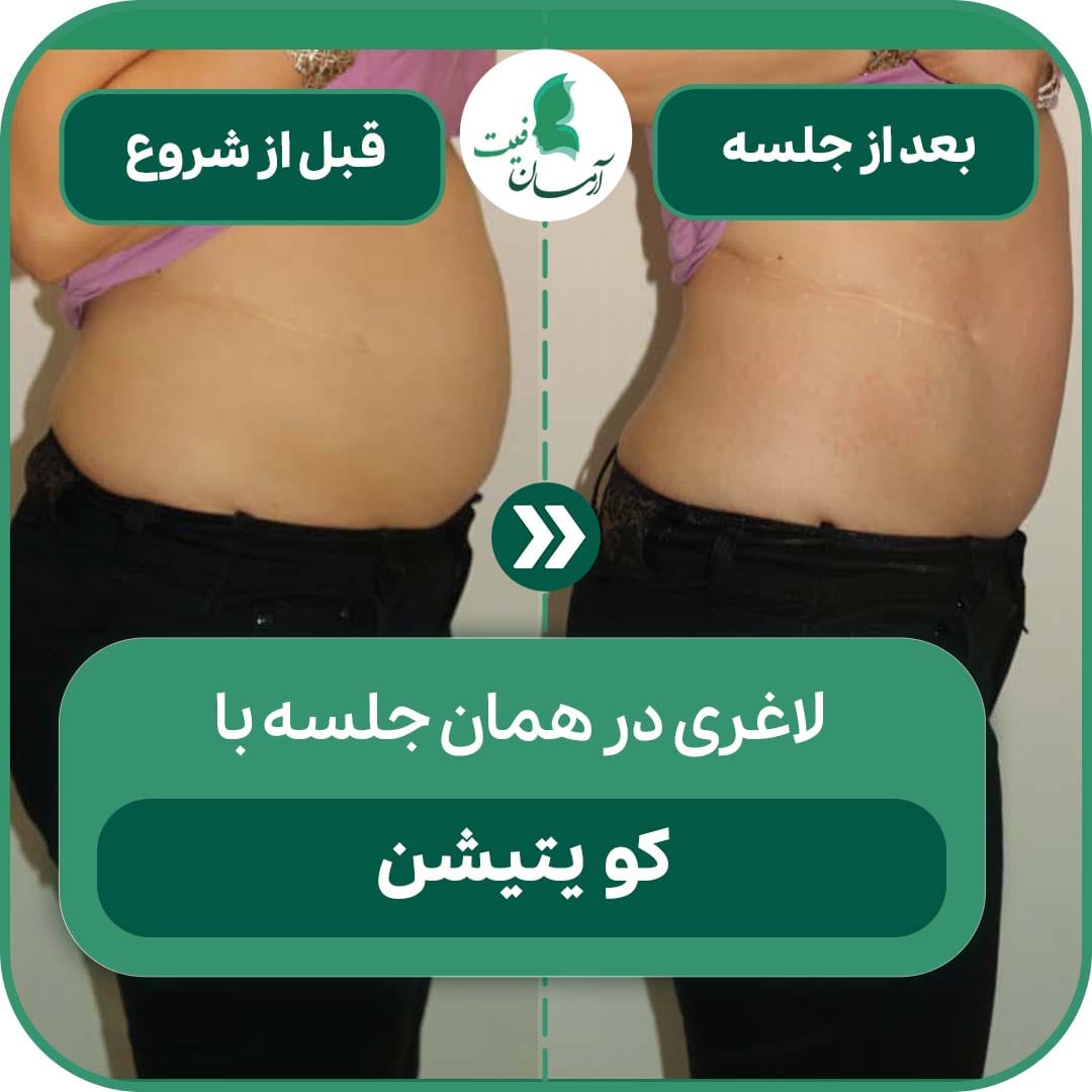 کاهش سایز با کویتیشن