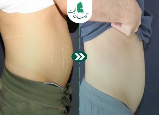  رفع چربی شکم با اسکالپشور