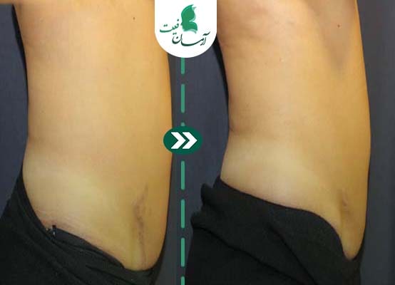  عضله سازی با دستگاه ems