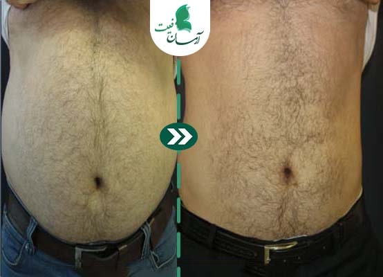  رفع چربی احشایی با رداستیم