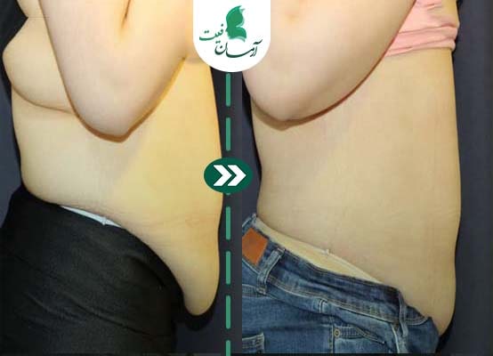  رفع چربی با کویتیشن